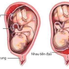 Những nguy hiểm của nhau tiền đạo mẹ bầu nên biết