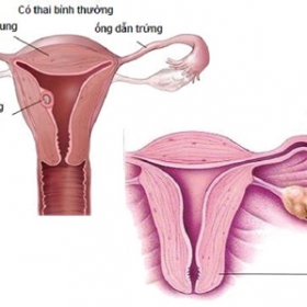 Mẹ bầu gặp nguy vì mang thai ngoài tử cung lại ngỡ có kinh nguyệt